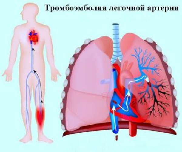 Эмболия легочной артерии