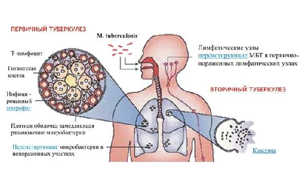 Факторы риска туберкулезной инфекции