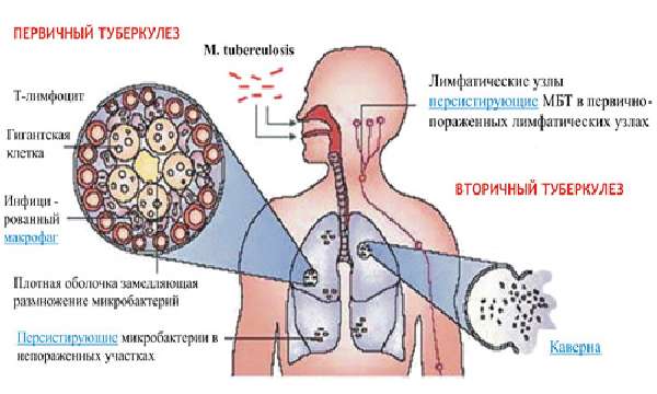 Особенности туберкулезной инфекции