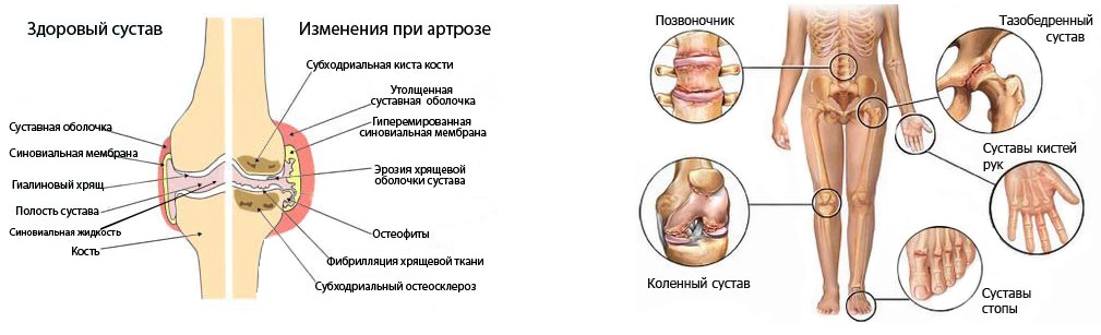 Артрит и артроз в чем. Остеоартроз коленного сустава осложнения. Схема поражения суставов при ревматоидном артрите. Поражение суставов при остеоартрозе.