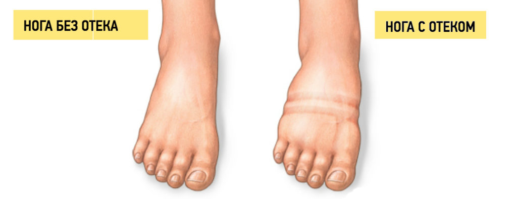 Отекают одна или обе ноги, почему опухают конечности — причины и лечение в vascul clinic