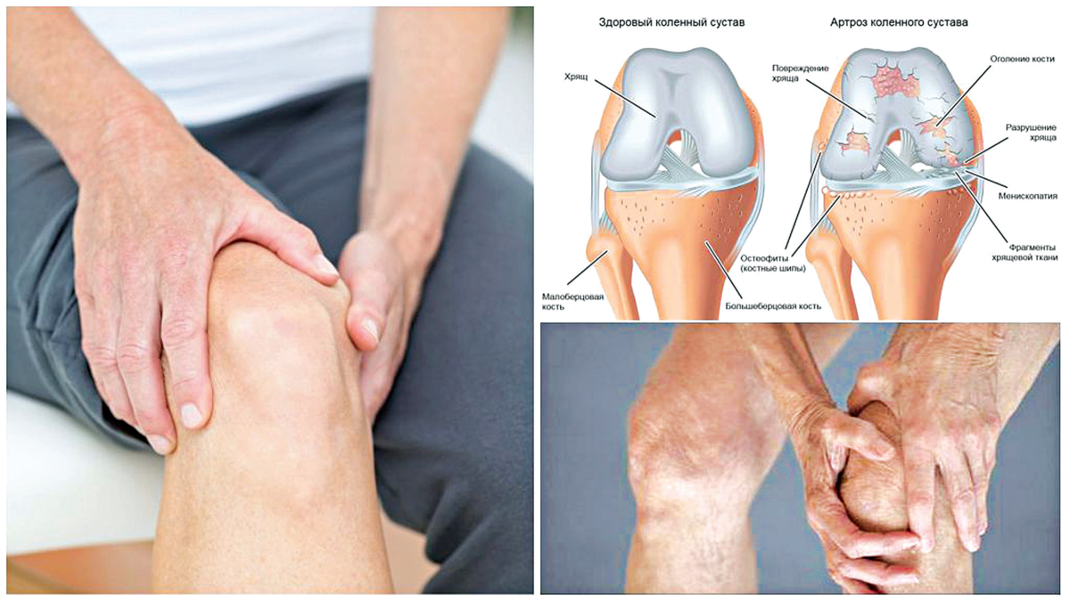 Клинические проявления гонартроз. Гонартроз контрактура. Артрозо-артрит коленного сустава. Гонартроз коленного сустава 2.