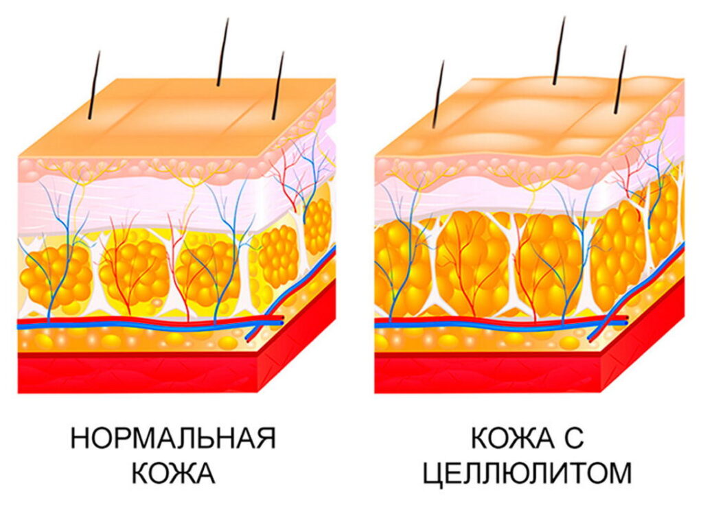 Подкожный жир рисунок