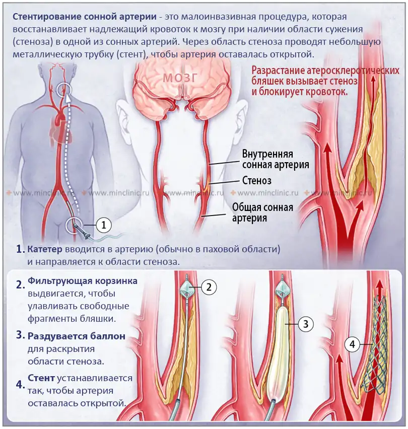 Закупорка сонной артерии фото
