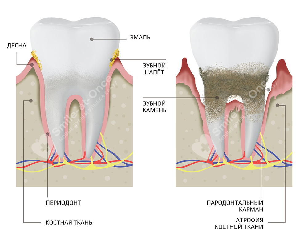 Воспаление десен болит зуб