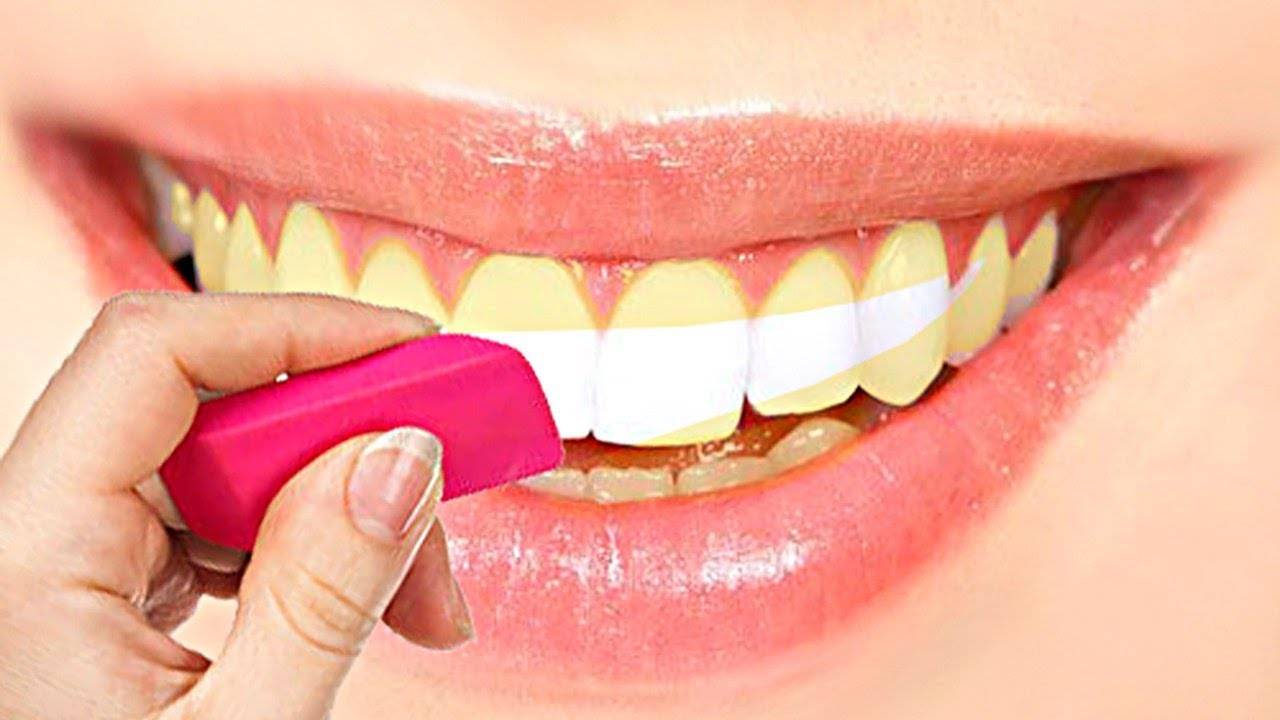 Как можно отбелить зубы в домашних условиях. Отбеливание зубов. Профессиональная гигиена полости рта.