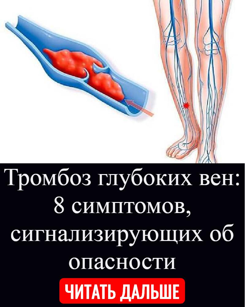 Тромбоз глубокой вены нижней конечности. Тромбоз внутренних вен голени. Тромбоз глубоких вен нижних конечностей. Тромбофлебит глубоких вен. Тромбо.