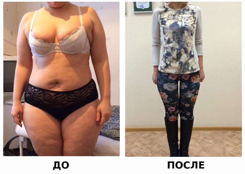 Вес после бариатрической операции. Уменьшение желудка для похудения до и после. Резекция желудка для похудения до и после. После операции по уменьшению желудка. Операция на желудок для похудения.