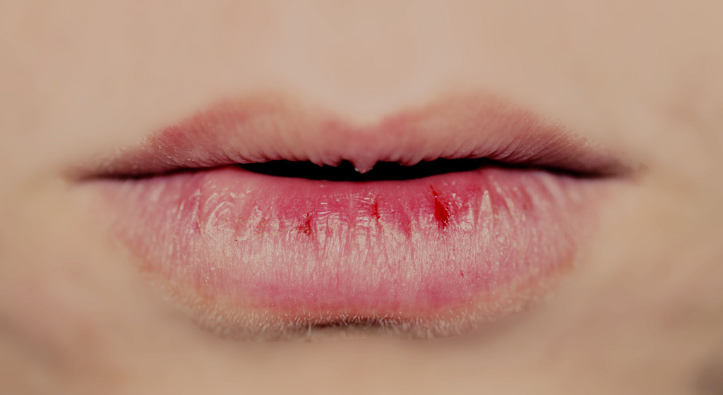 Как избавиться от сухости губ?