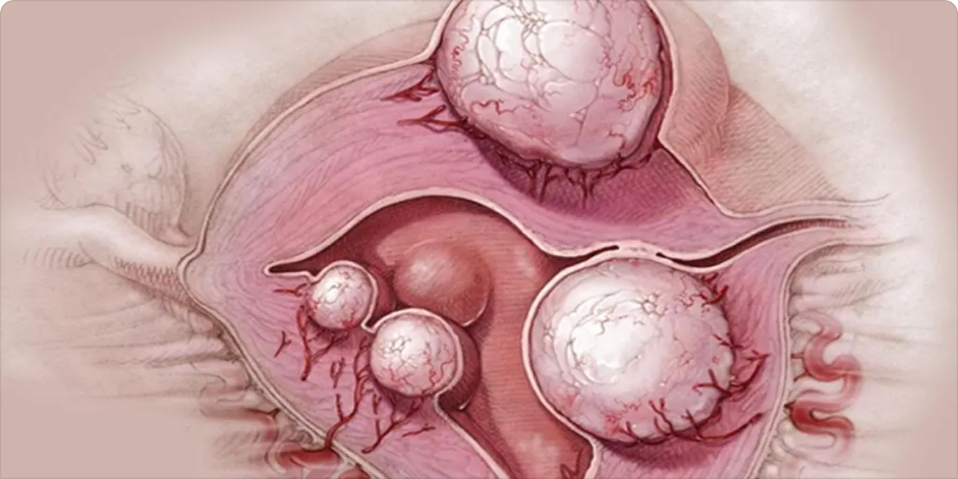 Рак яичников: симптомы, диагностика и лечение
