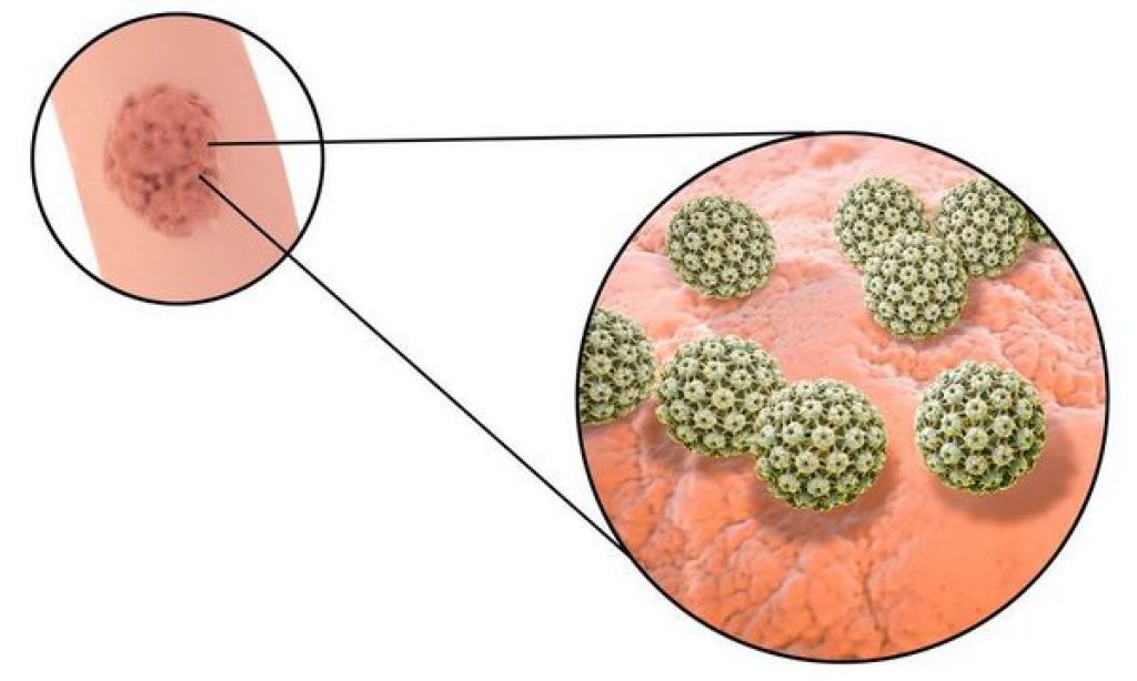 Вирус папилломы человека - признаки, причины, симптомы и лечение