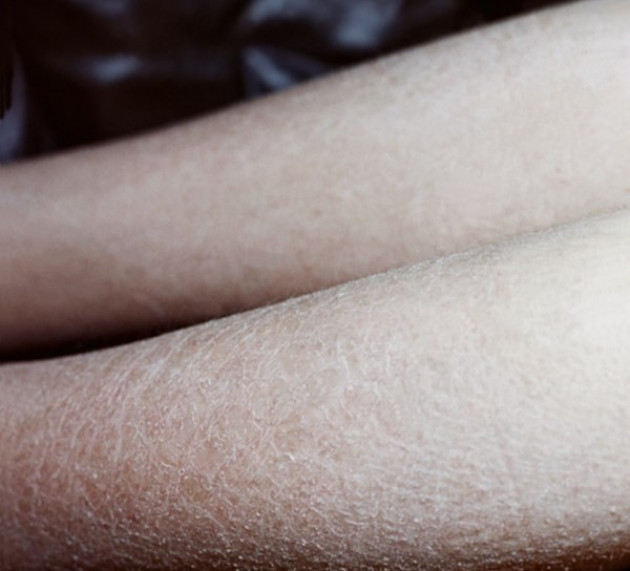 Причины и борьба с темной кожей на коленях и локтях