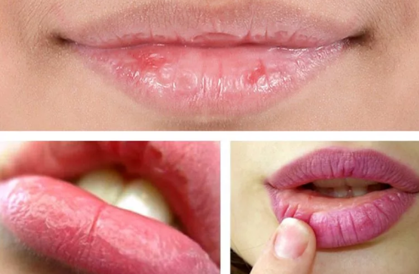 Почему сохнут губы: причины и способы лечения 