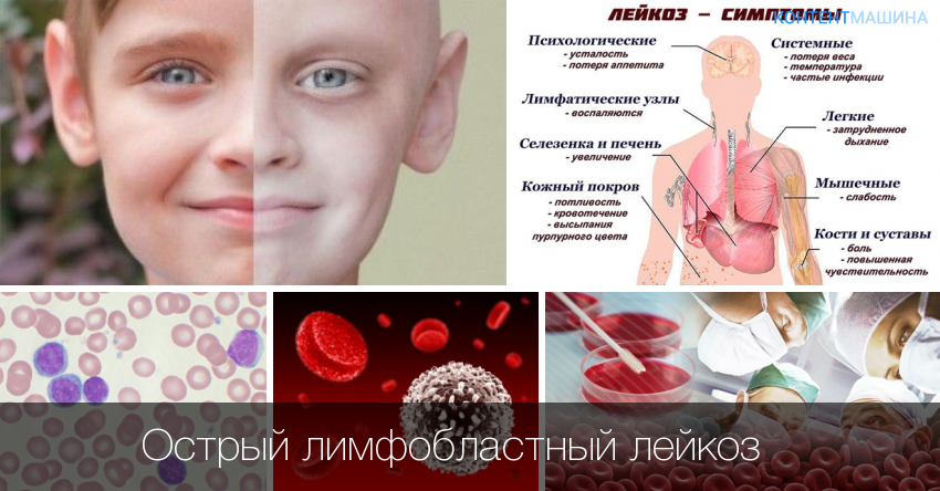 Лейкоз: симптомы, диагностика, лечение, стадии и профилактика рака крови