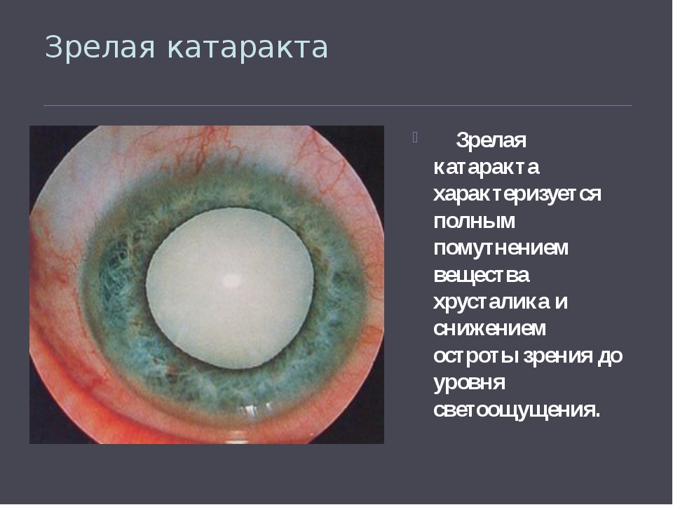 Катаракта. причины, диагностика, симптомы и лечение катаракты.