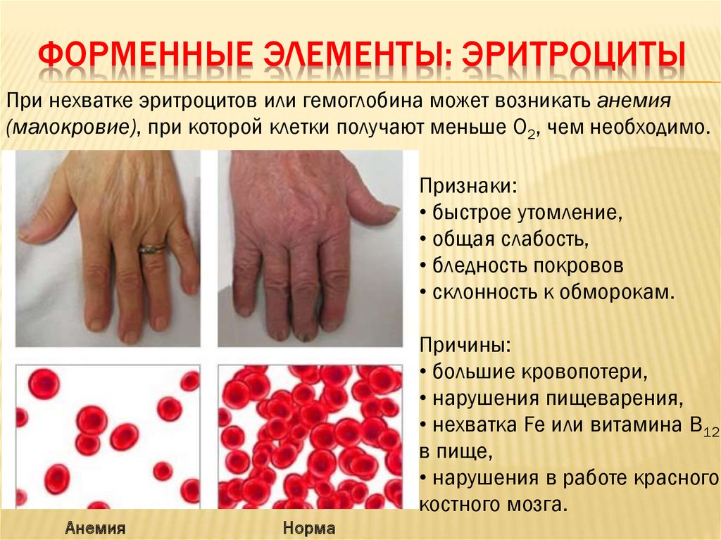 Анемия — симптомы, виды, диагностика, лечение | университетская клиника