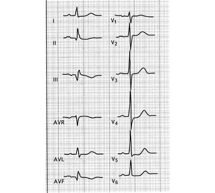 Как выглядит кардиограмма при инфаркте миокарда фото с расшифровкой