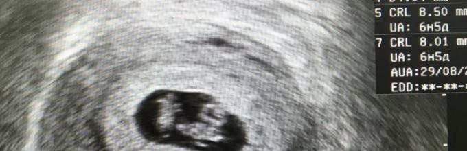 Беременность после неудачной. Эмбрион в день подсадки на УЗИ. УЗИ после переноса эмбрионов. Как выглядит эмбрион на 5 день после переноса.