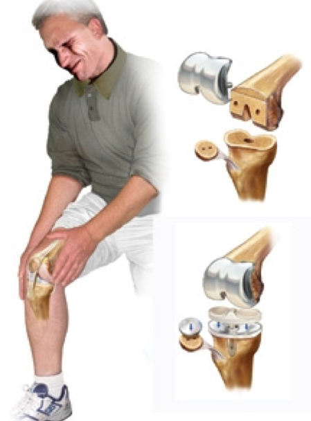 Эндопротезирование при артрозе коленного сустава. Сгибание коленного сустава. Эндопротезирование коленного.