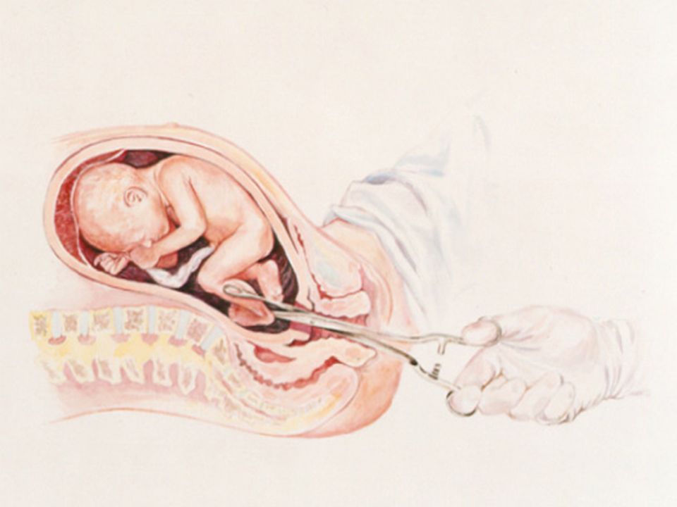 Последствия аборта: осложнения, беременность после аборта