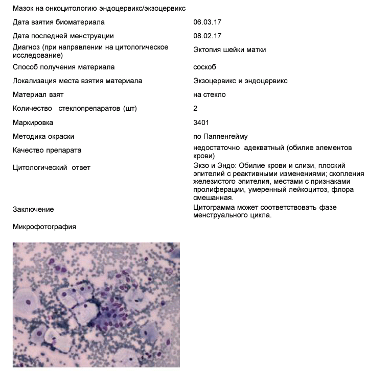 Анализ на цитологию. Расшифровка анализа цитологического исследования мазка. Цитологическое исследование мазка с шейки матки расшифровка. Цитологические заключения шейки матки. Цитологическое исследование микропрепарата тканей матки.