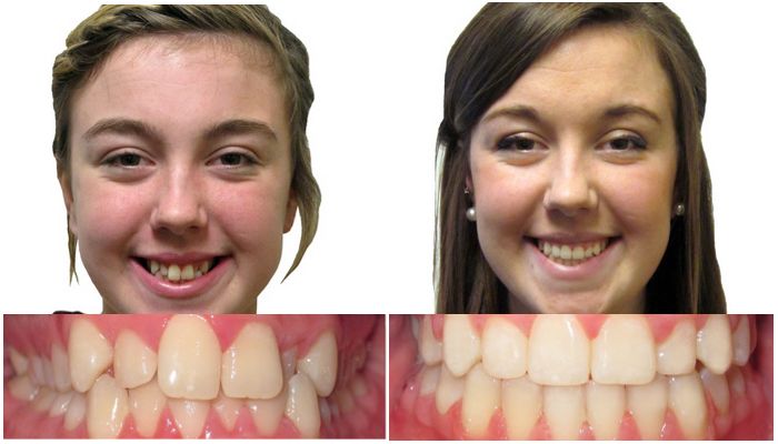 Изменения после брекетов. Ношение брекетов до и после. Исправление прикуса брекетами до и после. Исправление кривых зубов.