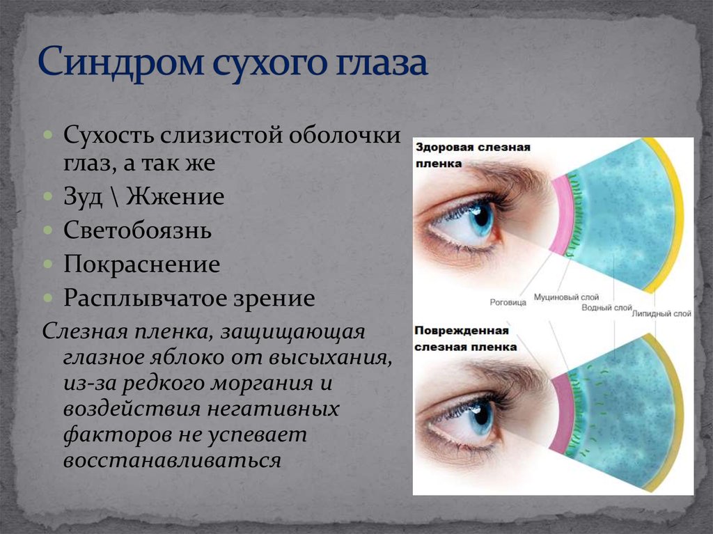 Причины симптома сухого глаза. Сидромсухового глаза. Синдром сухого глаза симптомы.