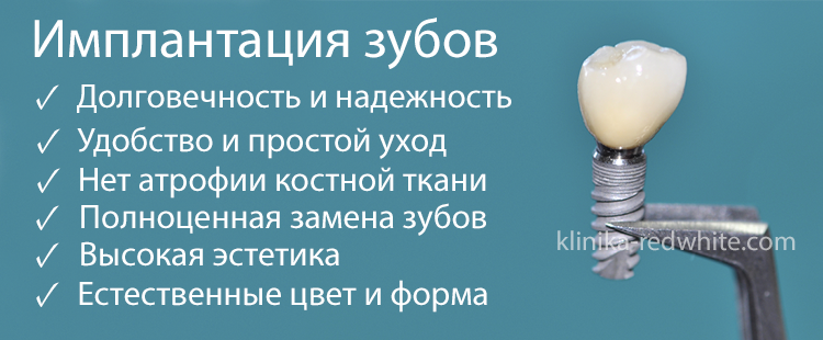 Имплант реклама. Реклама имплантации в стоматологии.