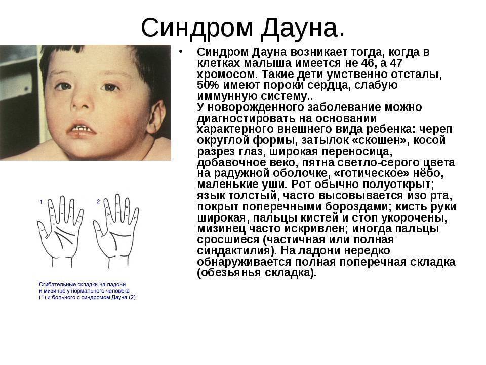 Фенотип ребенка с синдромом дауна. Характерные признаки проявления болезни синдрома Дауна. Синдром Дауна клиническая характеристика. Синдром Дауна у детей симптомы. Синдром Дауна кожная складка.