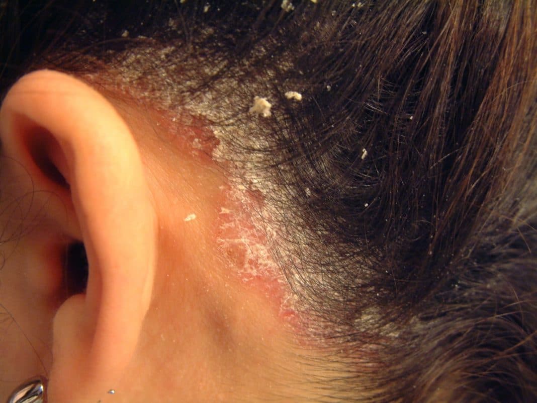 Влияние заболеваний печени на состояние кожи | клиника эксперт