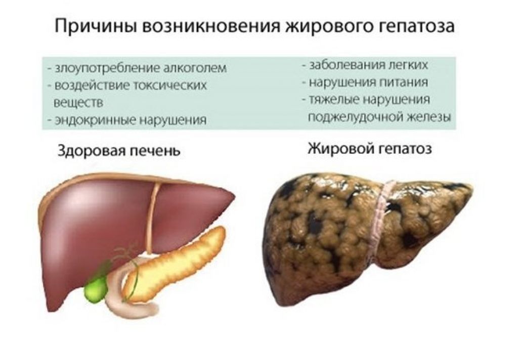 Стеатоз печени (гепатоз печени). неалкогольная жировая болезнь печени. метаболически ассоциированная жировая болезнь печени  - все о печени.ру