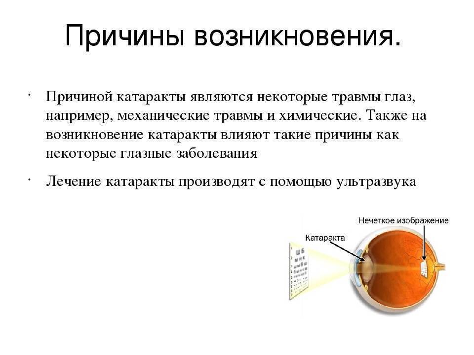 Катаракта глаза: симптомы и лечение