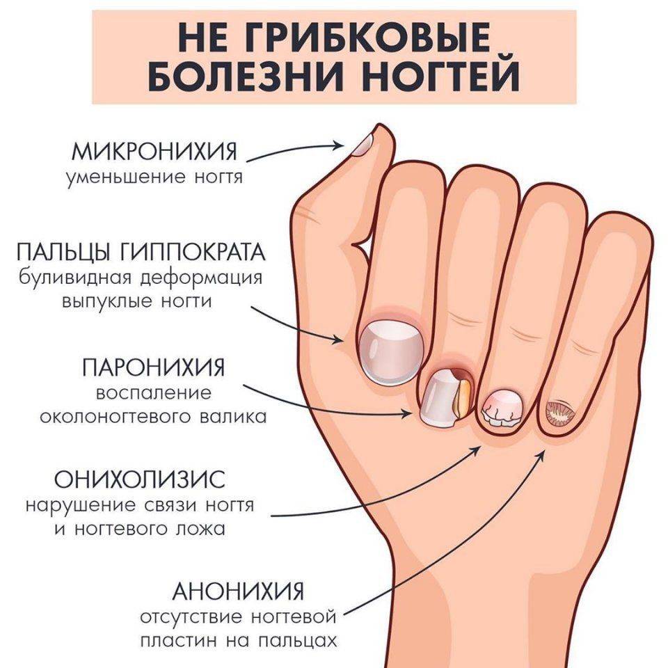 Микоз ногтей - симптомы, диагностика, лечение