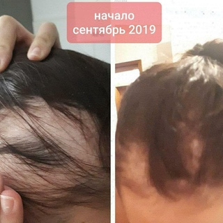 Восстанавливаются ли волосы после выпадения после родов