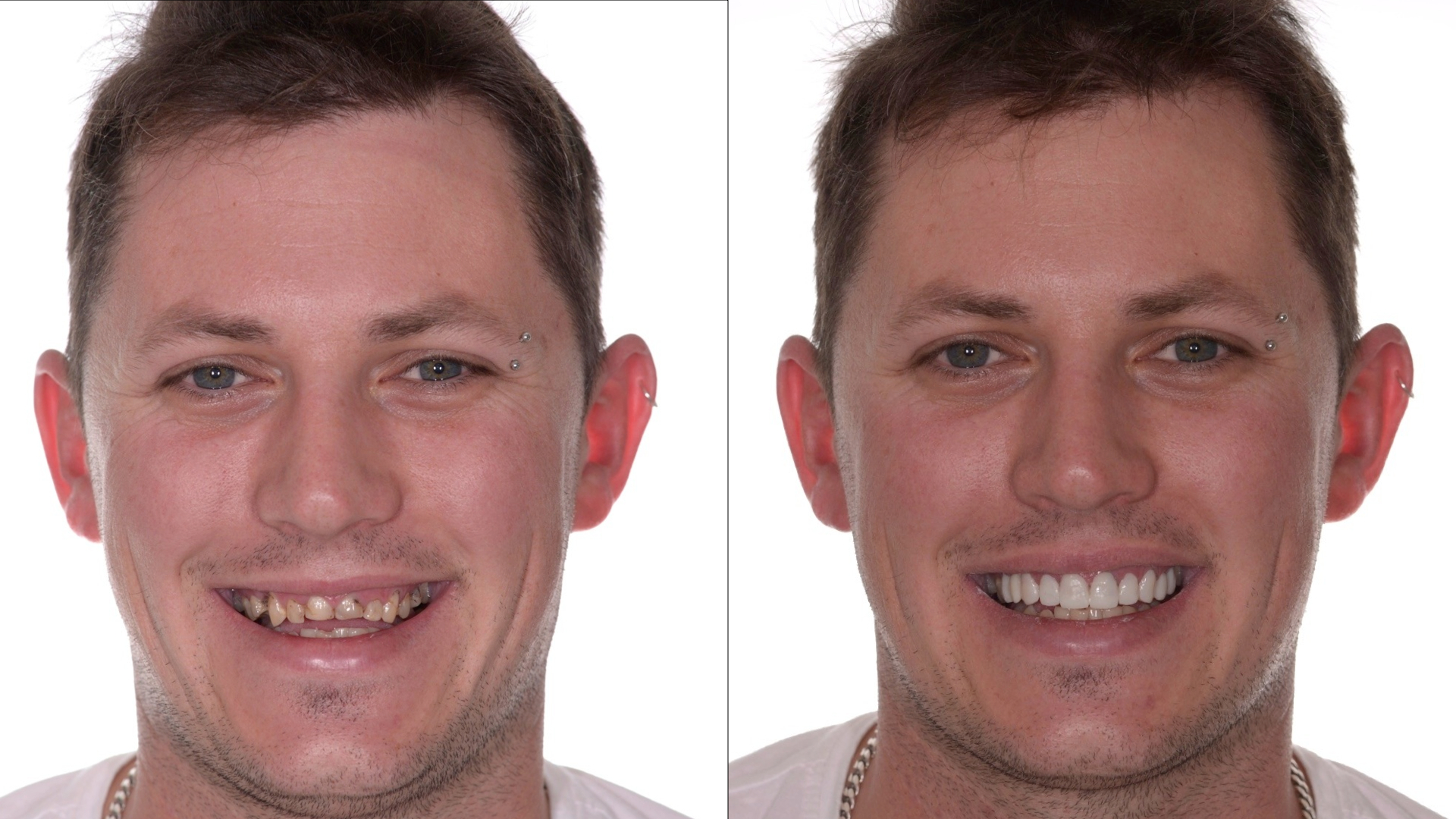 Форум людей страдающих. Имплантаты зубов до и после.