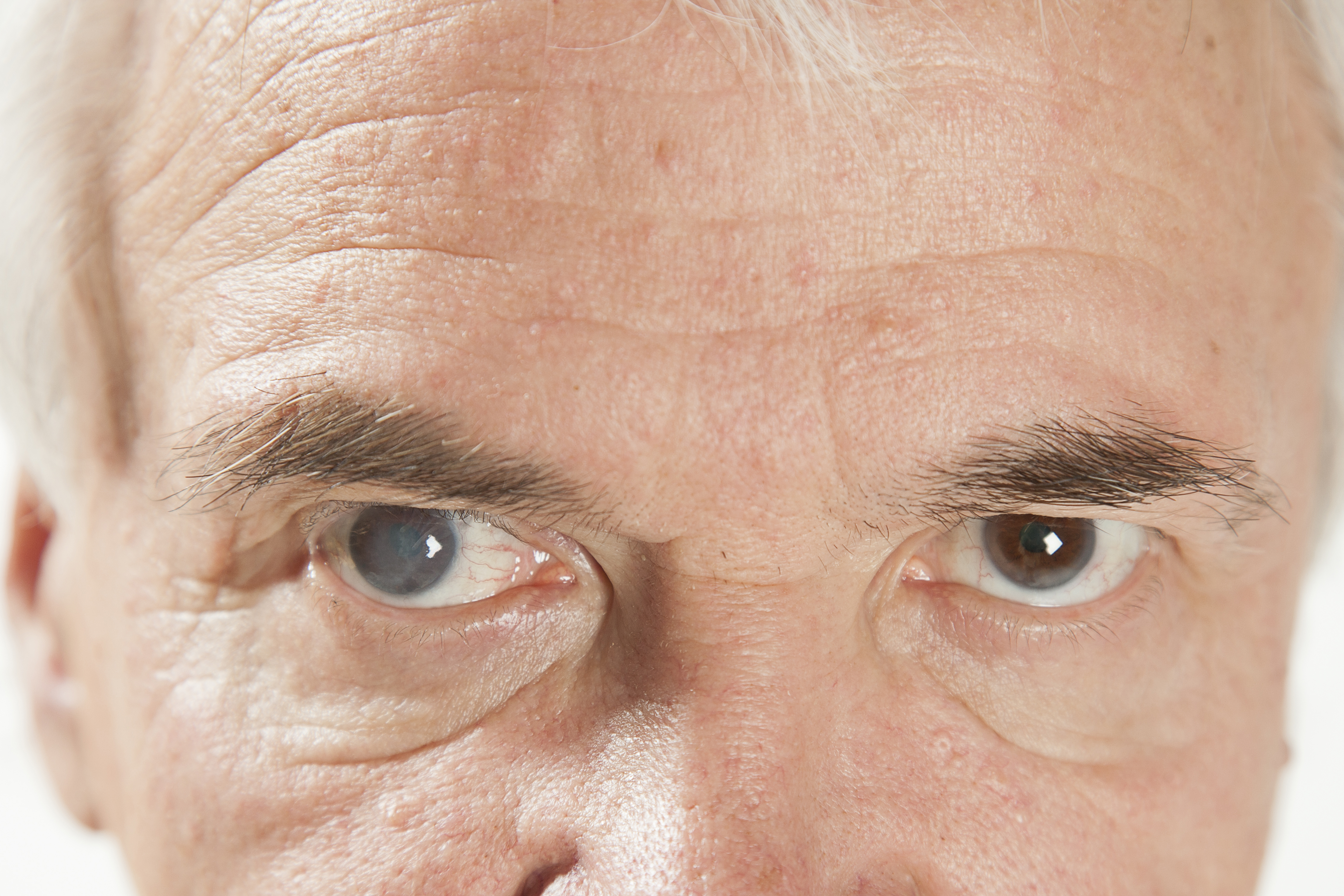 Зрение 1 симптомы. Старческая(сенильная)катаракта. Сенильная катаракта глаза.