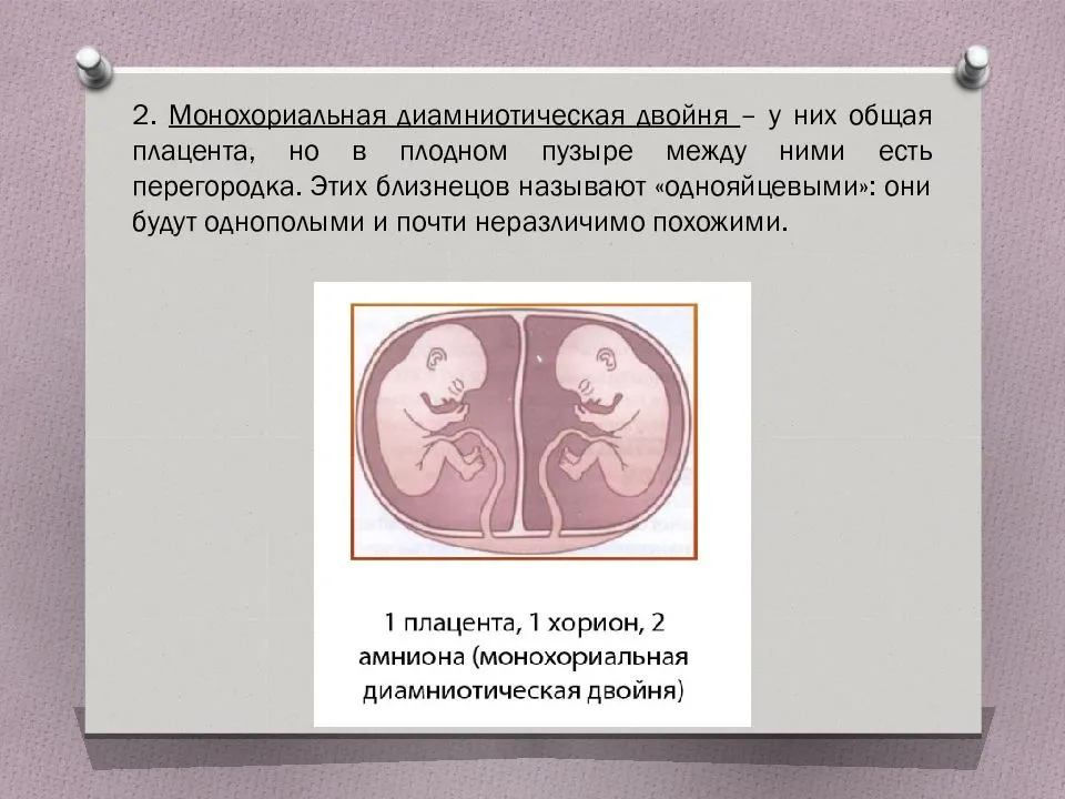 23 недели двойня. Монохориальная беременность двойней. Беременность дихориальная диамниотическая двойня. Монохориальная диамниотическая Близнецы. Монохориальная диамниотическая многоплодная беременность.
