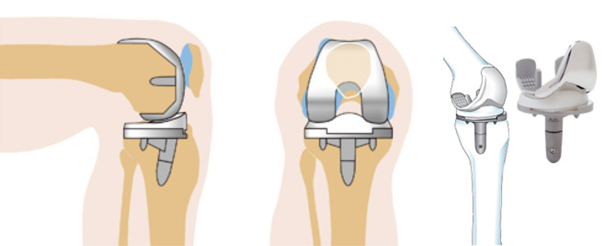 Эндопротез коленного сустава. Тотальное эндопротезирование коленного сустава DEPUY. Эндопротезирование коленного сустава этапы операции. Артроз коленного сустава эндопротез. Операции на коленном суставе стоимость