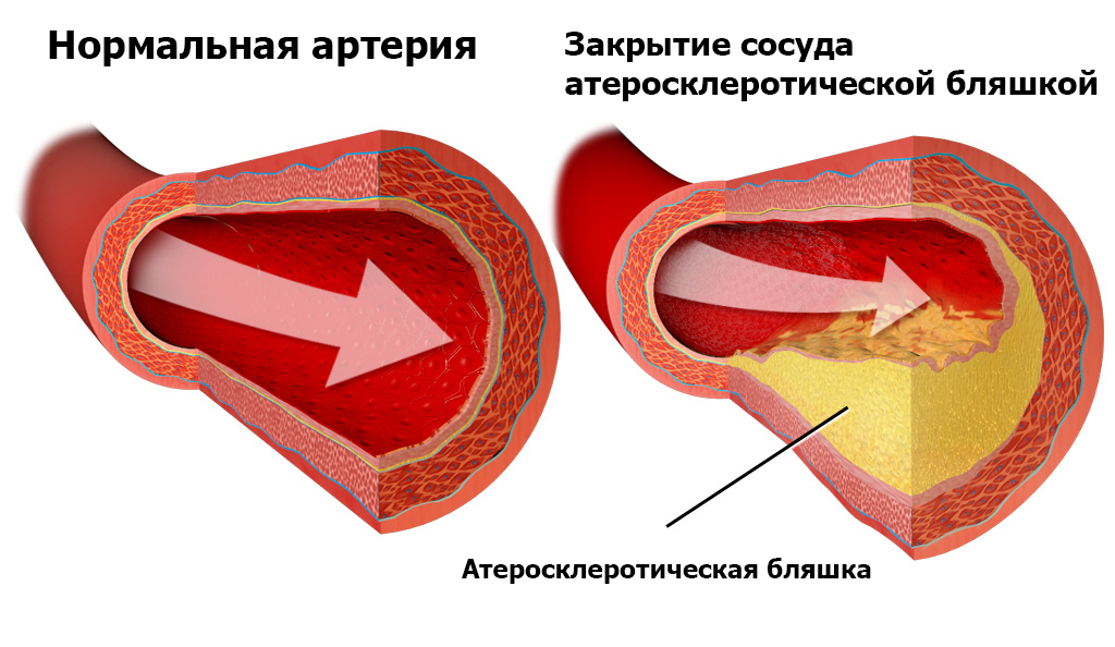 Атеросклероз брахиоцефальных артерий