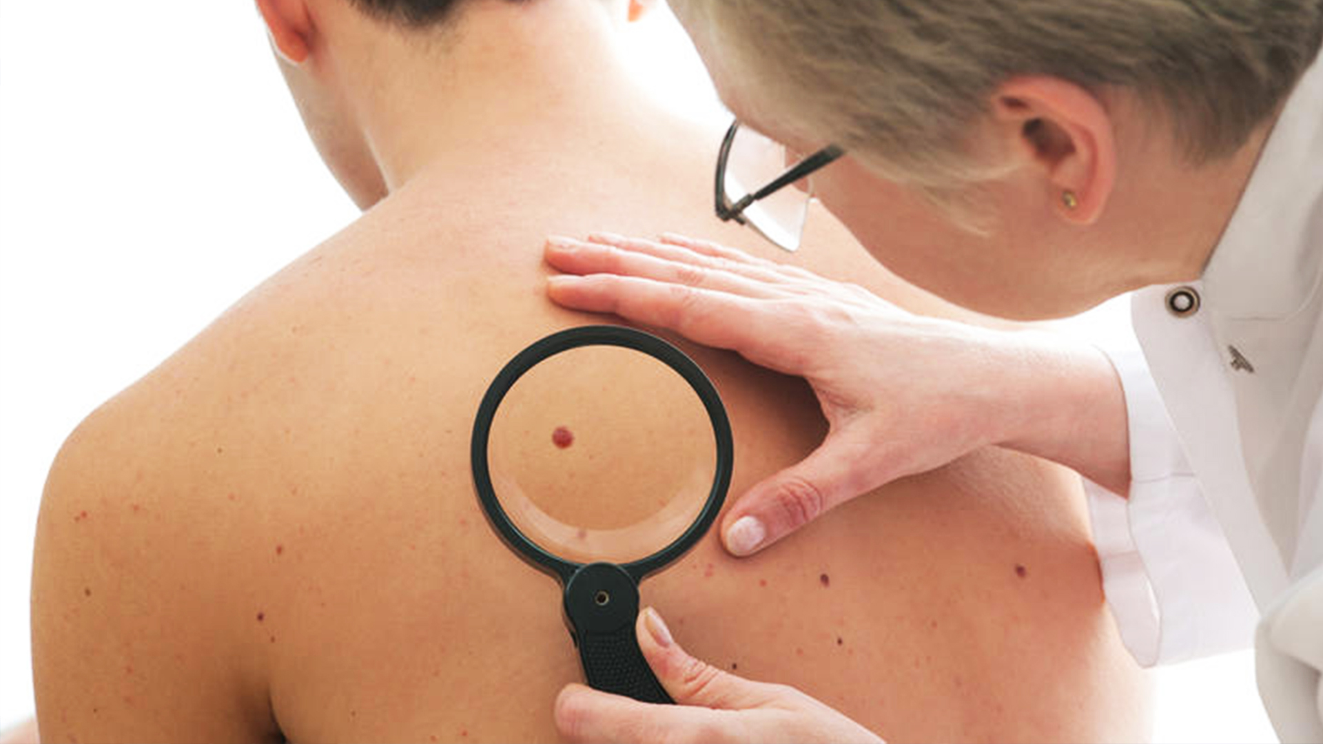 Диагностика меланомы (рака) кожи: онкомаркеры на меланому, биопсия и другие исследования