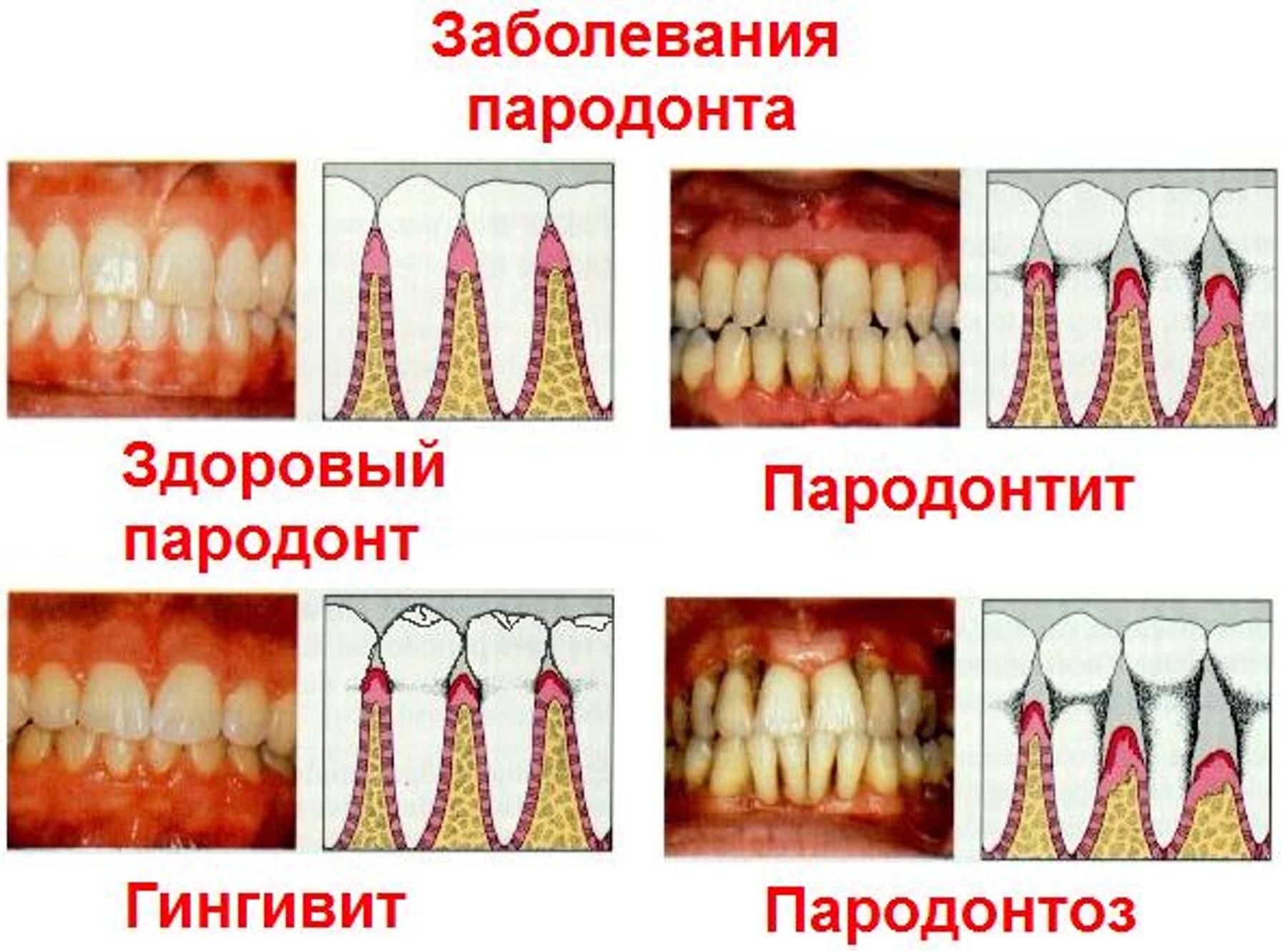 Почему зубы отличаются. Воспалительные заболевания пародонта гингивит пародонтит. Язвенно некротический гинг. Быстропрогрессирующий пародонтит. Острый катаральный гингивит.