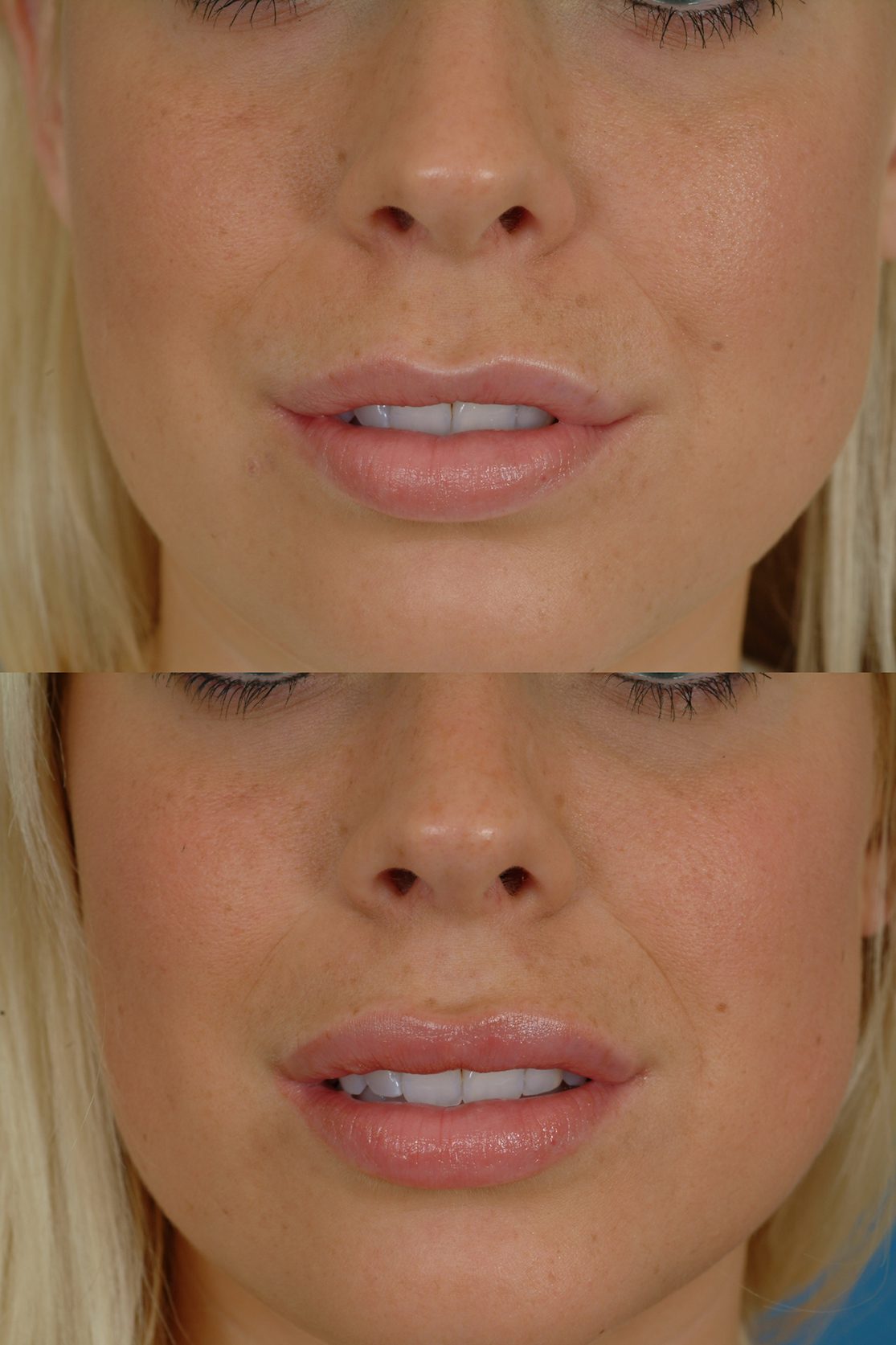 Увеличение губ до и после отзывы. Увеличенные губы красивые. Пластика губ гиалуроновой кислотой.