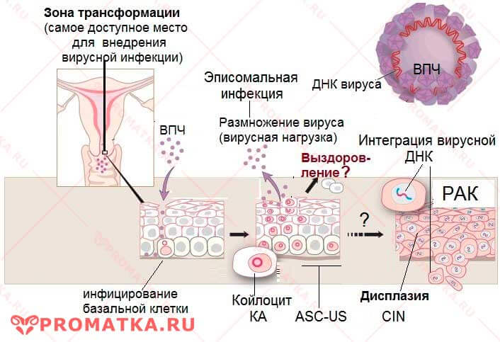 Вирус папилломы человека (впч) и рак шейки матки