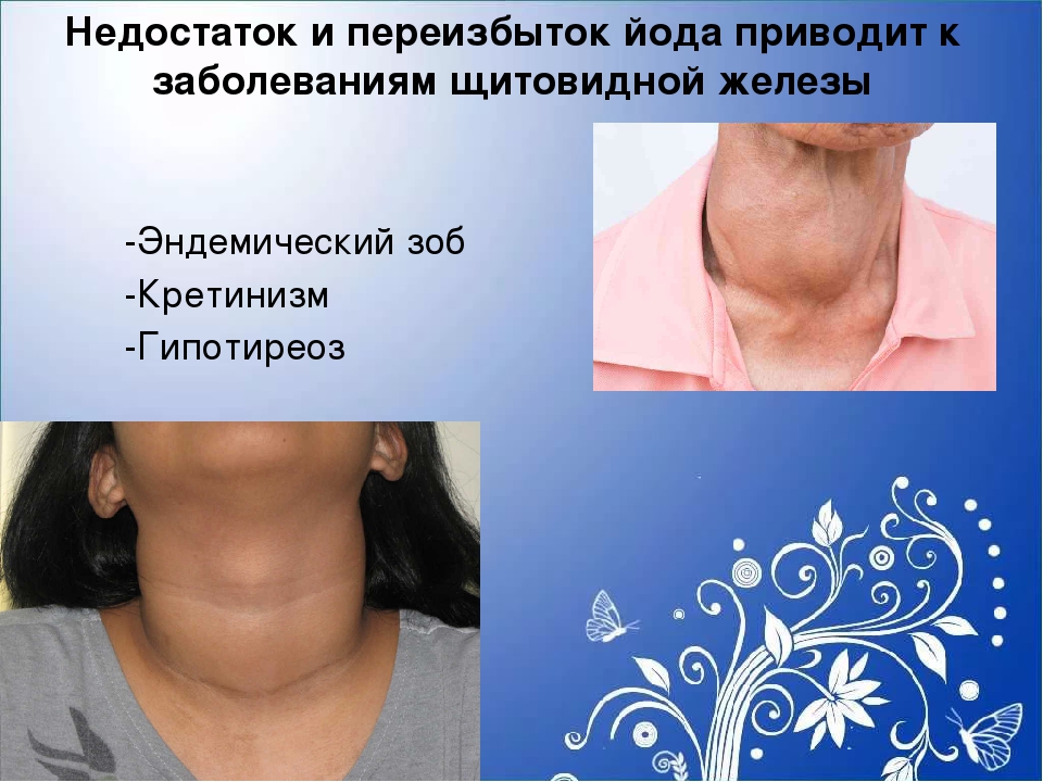 Болезнь щитовидки симптомы у женщин