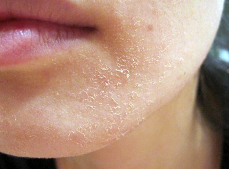 Почему сушит лицо. Шелушение кожи вокруг губ.