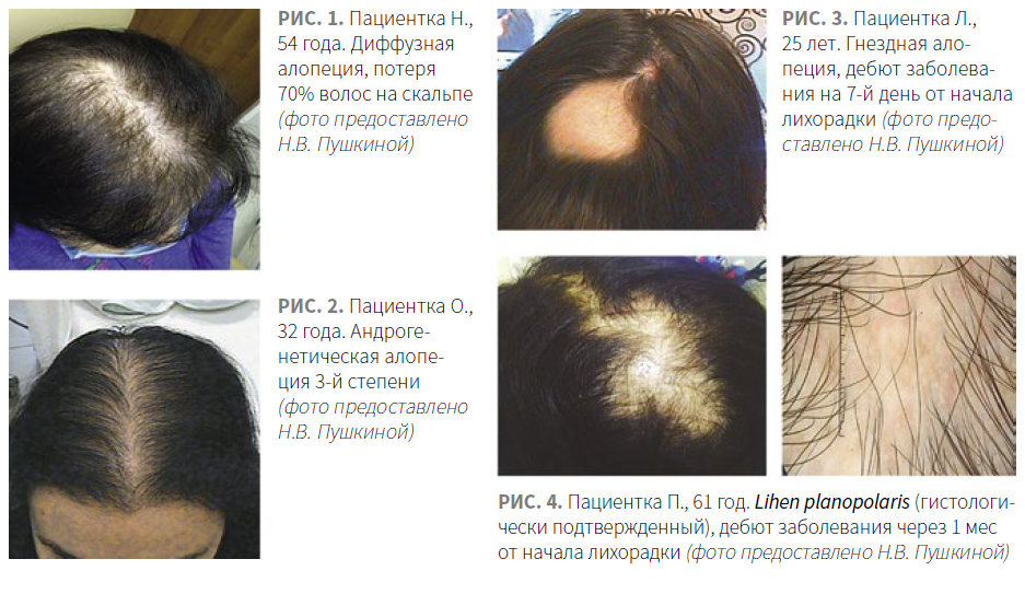 Выпадение волос алопеция у женщин. После ковида выпадают волосы что делать