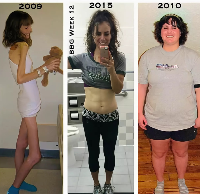 Была толстой потом похудела. Анорексия до и после похудения. Похудение до анорексии до и после. Анорексия до и после до и после похудения. Набрала вес до и после.