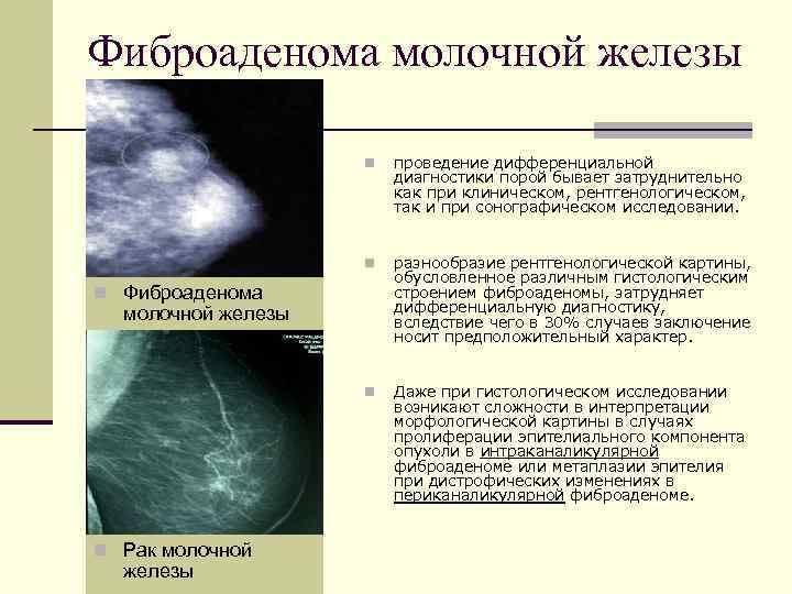 Рак молочной железы 1 стадии операция. Фиброаденома молочной железы дифференциальный диагноз. Фиброаденома молочной железы 1б. Дифференциальная диагностика фиброаденомы фиброаденома. Фиброаденома молочной железы патанатомия патогенез.