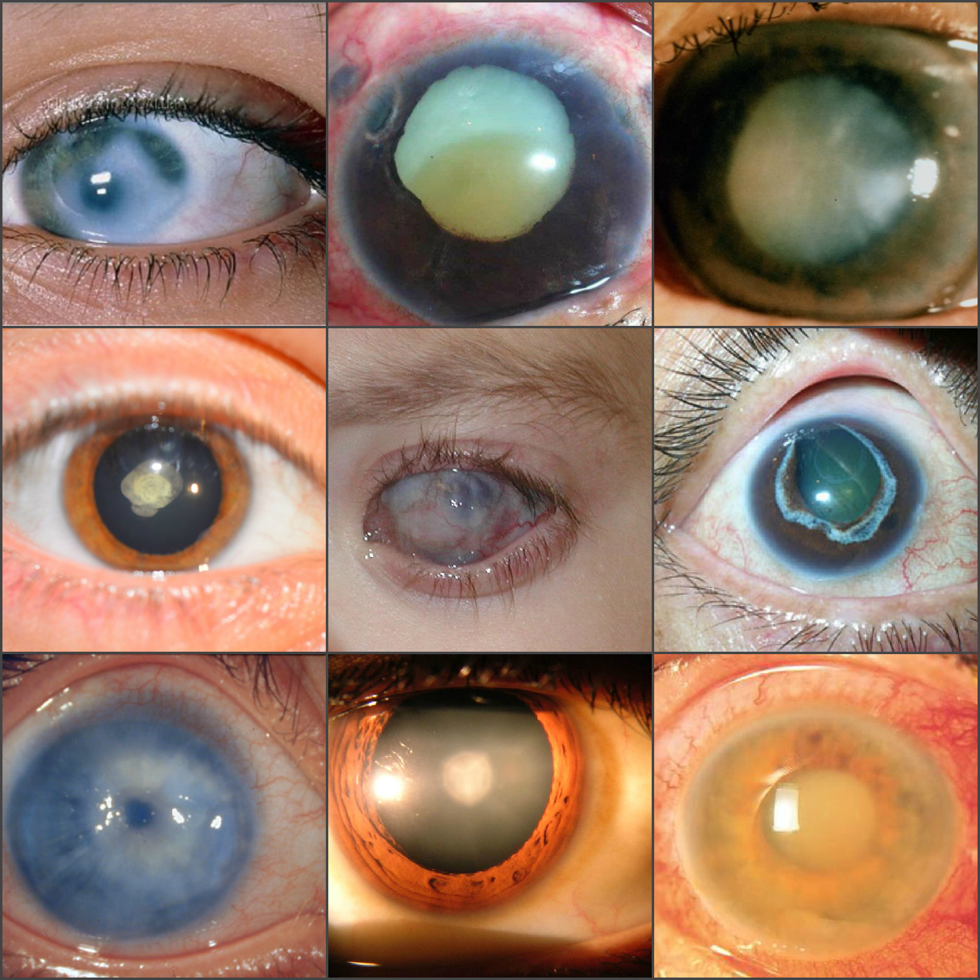 «синий глаз» или коварная глаукома