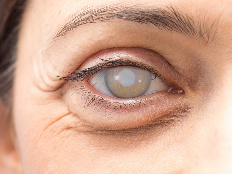 Начальная катаракта: лечение, причины, симптомы